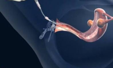 人工流产后建议6个月后再选择试管婴儿手术？人工流产术后处理注意事项